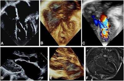 Case report: Active clinical manifestation of endocardial fibroelastosis in adolescence in a patient with mitral and aortic obstruction–histologic presence of endothelial-to-mesenchymal transformation